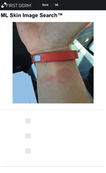 Skin Image Search - First Derm AI - Fitbit Rash Eczema