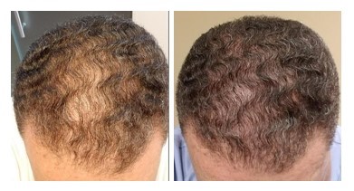 Dermatologist Charles E. Crutchfield III . Announces Platelet Rich Plasma  to Treat Hair Loss (Alopecia)
