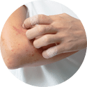 Eczema Treatment