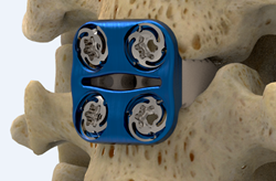 SpineFrontier Less Exposure Surgery Technology, Invue Inset