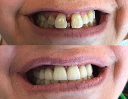 At Mexico Dental Network, in Tijuana, up to 8 crowns can be made in one same day dental visit.