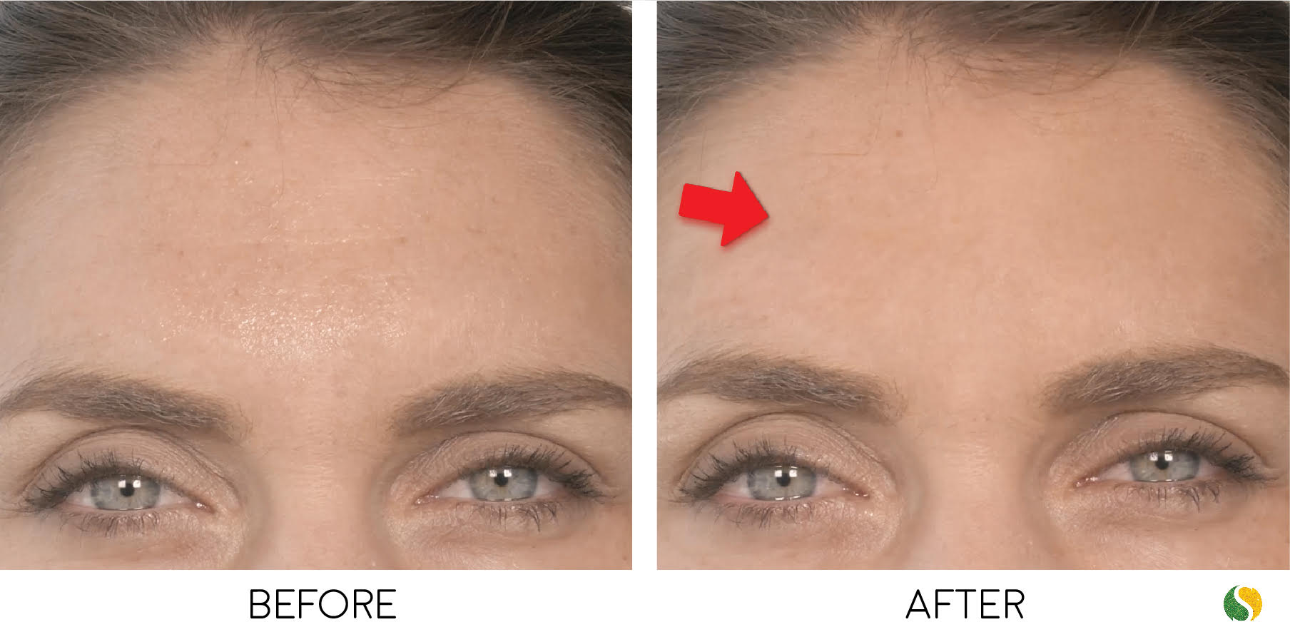 Bratoxinsta Clinically Proven Wrinkle Serum Delivers Immediate Results In 82 Of Subjects