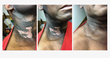 After applying Moore Relief Revitalizing & Burn Lotion to this patient’s untreated radiation-burn scars (left), rapid healing was visible after two days (center) and after two weeks (right).