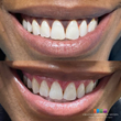 Creative Dentistry &amp; Med Spa of Atlanta Now Using the NV&#174; PRO3 Microlaser for Exceptional Cosmetic Outcomes in Gum Bleaching