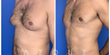 Azouz Plastic Surgery in Dallas, TX, Reports a Significant Increase in Male Patients Receiving Breast Reduction Surgery and other Procedures at the Practice