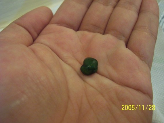 Какого размера камень может выйти сам. Зеленые билирубиновые камни.