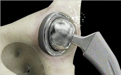 Photo showing metal debris wear of the DePuy ASR XL metal-on-metal hip replacement system