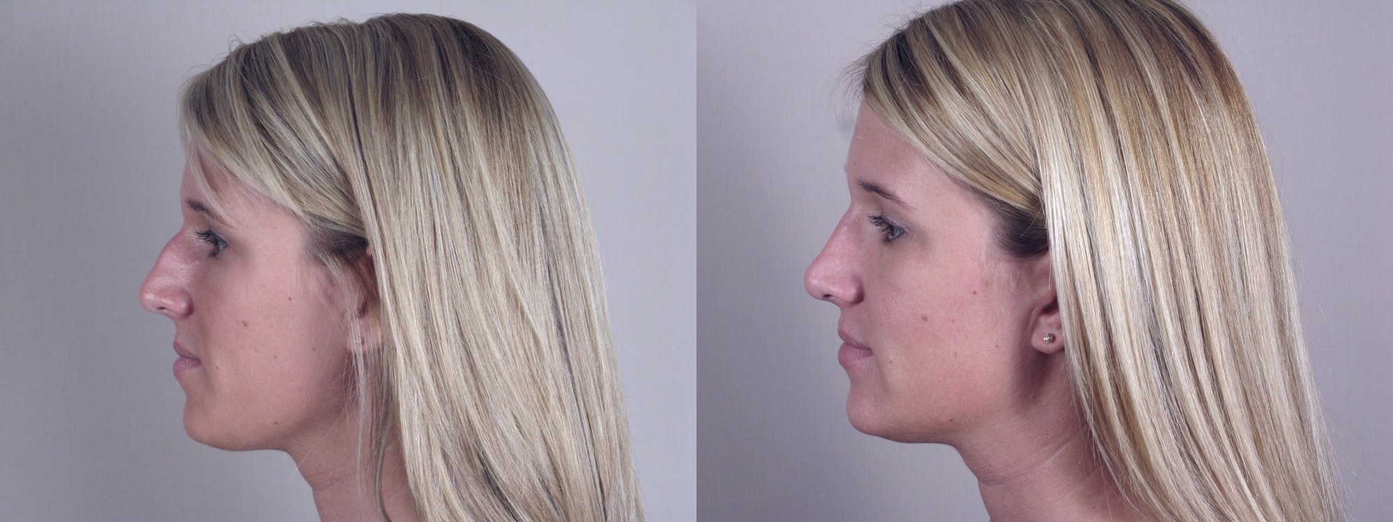 Every New Jersey Rhinoplasty Procedure is as Unique as