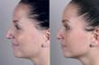 Rhinoplasty New Jersey Patient Image from Parker Center for Plastic Surgery