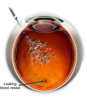 Intraocular injection
