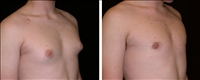 Before and After Gynecomastia Surgery San Francisco, CA