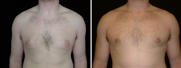Before and After  Gynecomastia Surgery San Francisco, CA