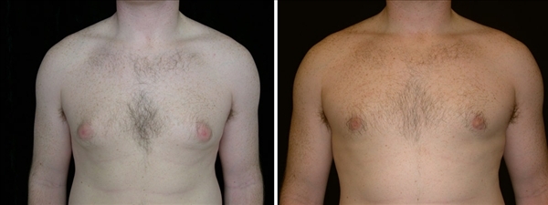 Before and After  Gynecomastia Surgery San Francisco, CA