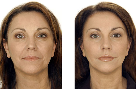 Non Surgical Face lift before & after.