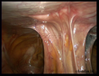 Adhesions of the small bowel attached to the abdominal wall are shown in the photo above. Photo courtesy of Dr. Daniel Kruschinski, EndoGyn, Ltd., Braunschweig, Germany (endogyn.com)