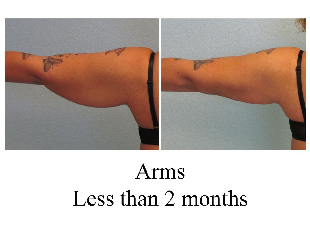Arms Liposuction