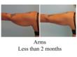 liposuction arms
