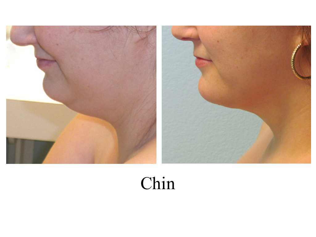 Chin Liposuction with Smart Lipo