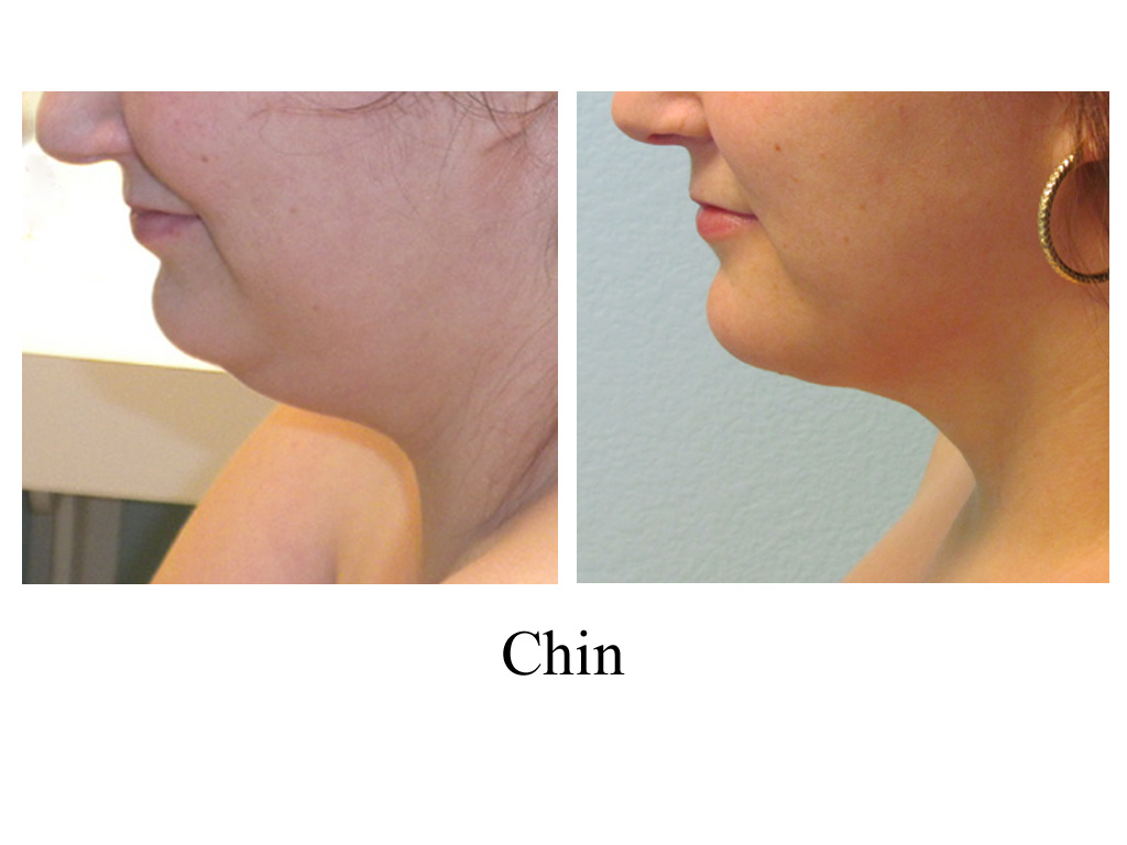 Chin Liposuction