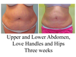 large volume liposuction, liposuction of abdomen, liposuction before and after