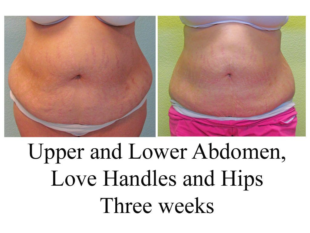 Large volume liposuction makes Big Changes