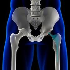 DePuy Hip Replacement severe adverse events
