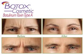 Botox before & after