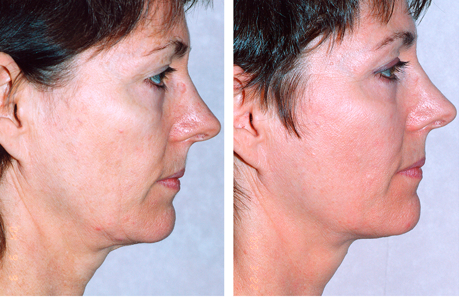 Thermage Before and After Chin fat