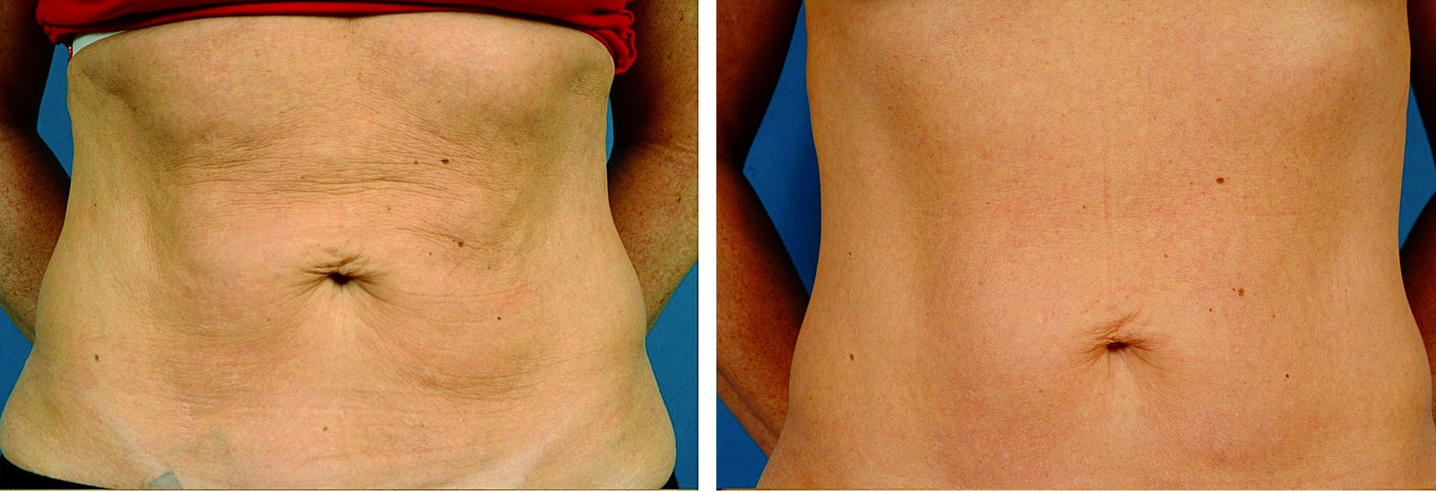 Thermage skin tightening to belly