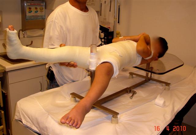Pediatric Spica Table in use with the Partial Spine Support