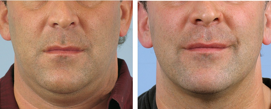 Man chin and neck non-surgical fat reduction