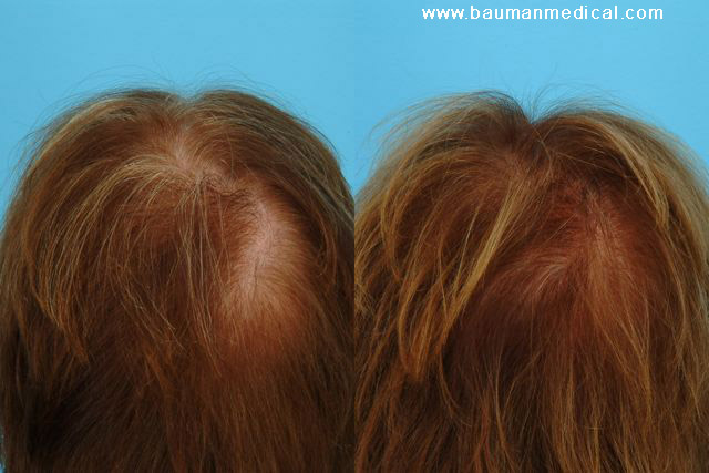 Formula 82M Treatment - Before and After