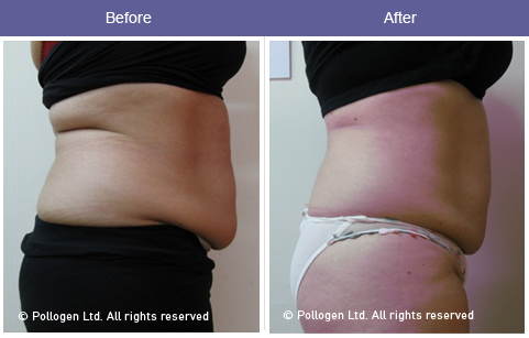 Tummy tightening and circumference reduction with TriLipo Technology