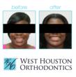 Images of before and after treatment of an open bite with Invisalign