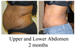 abdominal liposuction, liposuction of the abdomen, myshape lipo, liposuction las vegas, trevor schmidt