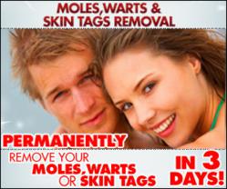 Moles Warts Removal Review