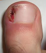painful ingrown nail
