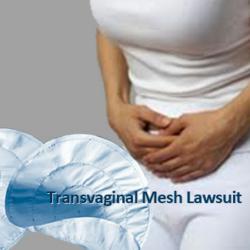 Transvaginal Mesh Complication And Lawsuit Update