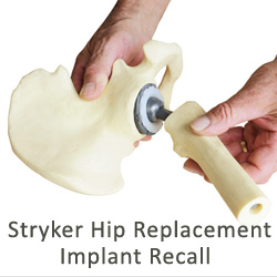 If you or someone you love were injured by Stryker Rejuvenate and ABG II Modular-Neck Hip replacement device, please visit yourlegalhelp.com, or call toll-FREE 1-800-399-0795