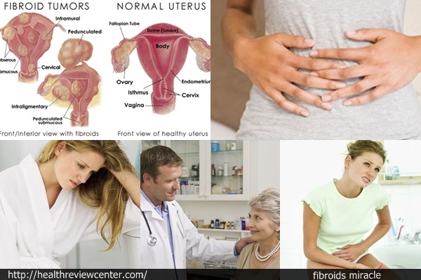 Fibroid Treatment | How “Fibroids Miracle” Helps Women Remove Fibroid ...