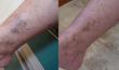 Before and After Spider Vein Treatment