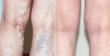 Before and After Spider and Varicose Vein Treatment