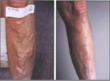 Before and After Varicose Vein Treatment