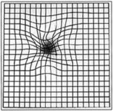 Amsler grid distortion is a common symptom of many macular diseases.