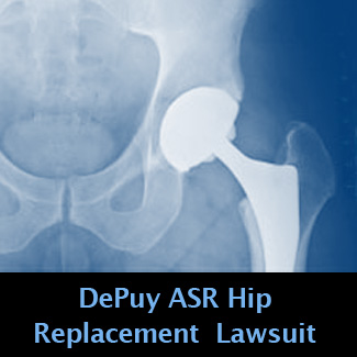 DePuy ASR Hip Replacement Lawsuit Documents Show Failure Rate Close to ...