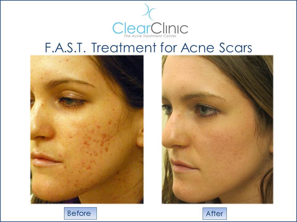 F.A.S.T. procedure results for acne scars