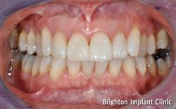 dental implant treatment for missing teeth