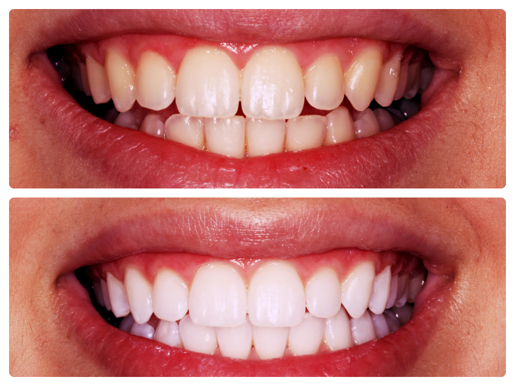 Best Bleaching Solutions - How To Whiten Your Teeth Cheap And Easily