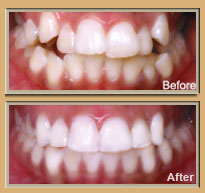 6 Month Smiles Available at South Charlotte Dentistry, Charlotte NC