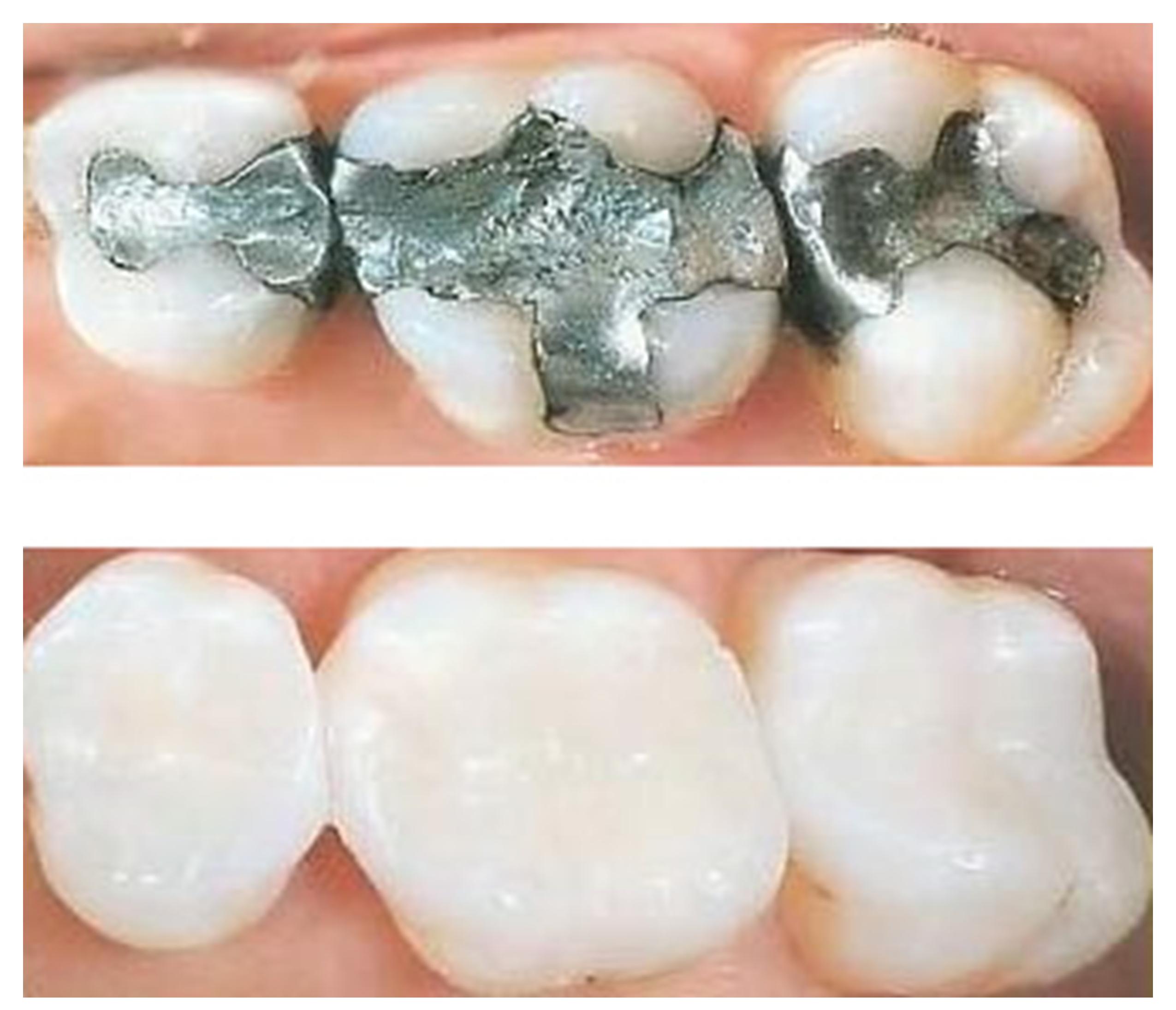 CEREC Tooth Crowns Are Now Offered by Cosmetic Dentist Dr. Irina Feldbein